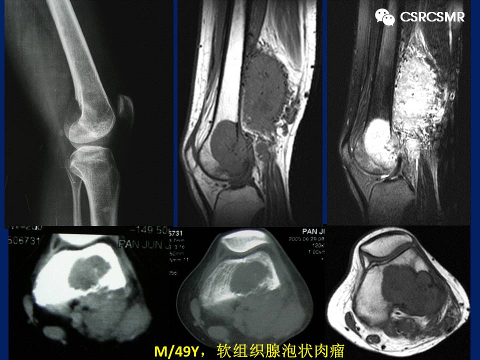 【PPT】软组织肿瘤影像学诊断价值