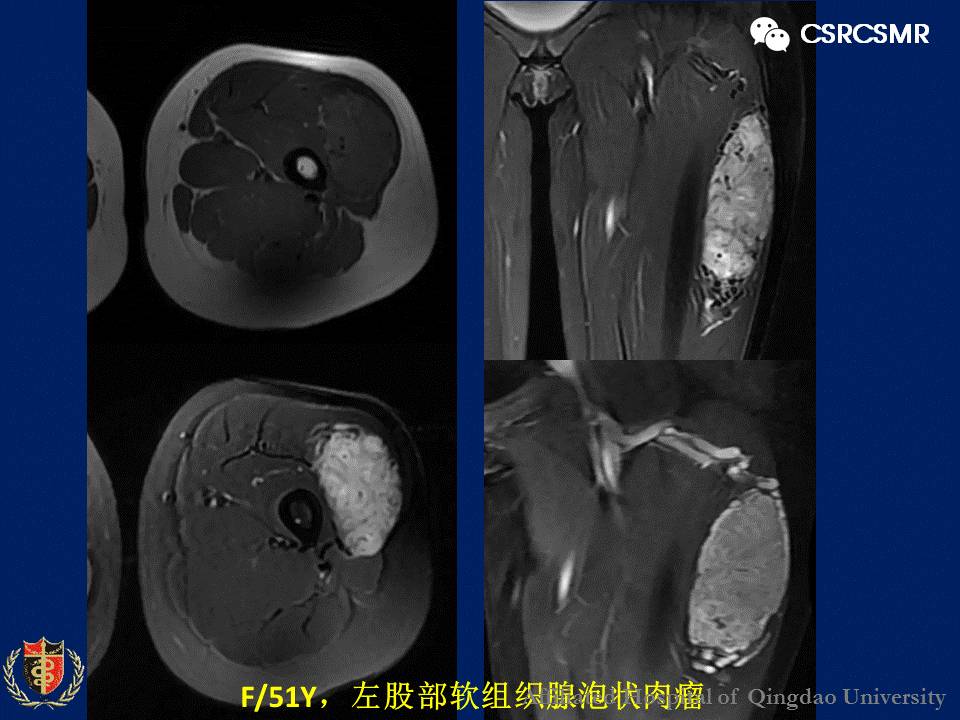 【PPT】软组织肿瘤影像学诊断价值