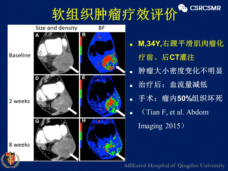 【PPT】软组织肿瘤影像学诊断价值