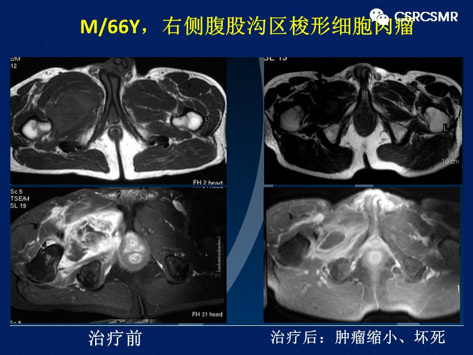 【PPT】软组织肿瘤影像学诊断价值