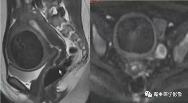子宫良性病变,应想到这6种疾病 子宫良性病变,应想到这6种疾病
