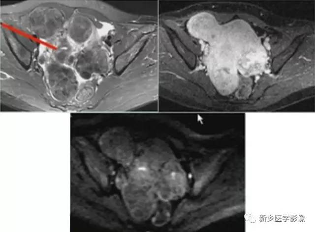 子宫良性病变,应想到这6种疾病 子宫良性病变,应想到这6种疾病