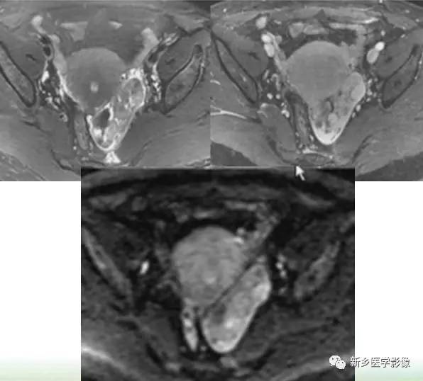 子宫良性病变,应想到这6种疾病 子宫良性病变,应想到这6种疾病