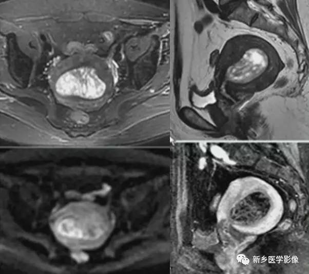 子宫良性病变,应想到这6种疾病 子宫良性病变,应想到这6种疾病