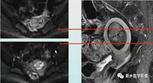 子宫良性病变,应想到这6种疾病 子宫良性病变,应想到这6种疾病
