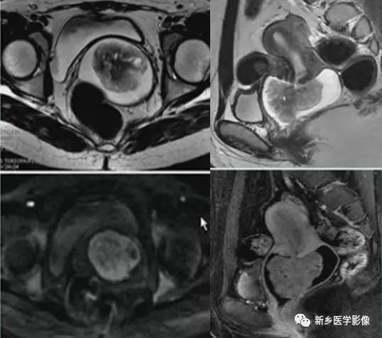 子宫良性病变,应想到这6种疾病 子宫良性病变,应想到这6种疾病