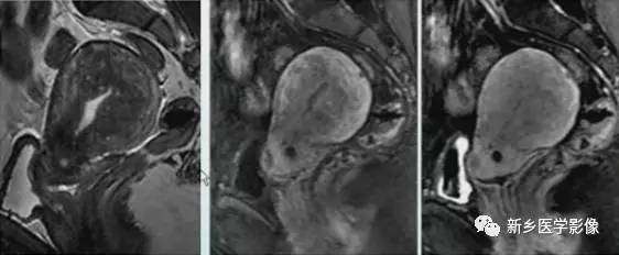 子宫良性病变,应想到这6种疾病 子宫良性病变,应想到这6种疾病
