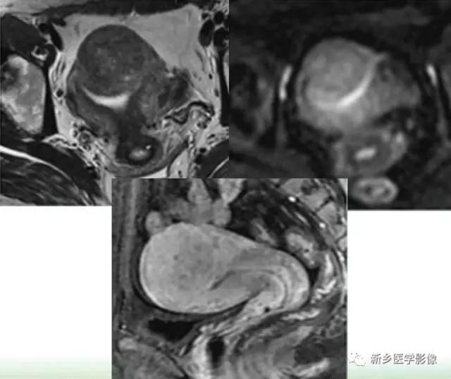 子宫良性病变,应想到这6种疾病 子宫良性病变,应想到这6种疾病