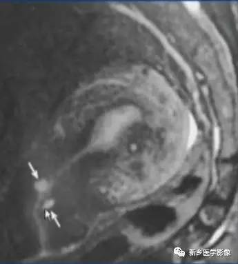 子宫良性病变,应想到这6种疾病 子宫良性病变,应想到这6种疾病