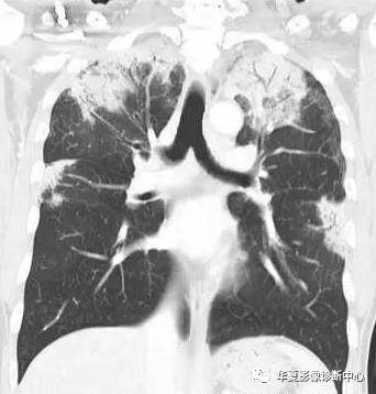 弥漫性肺泡实变影像的鉴别诊断 弥漫性肺泡实变影像的鉴别诊断