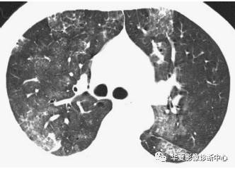弥漫性肺泡实变影像的鉴别诊断 弥漫性肺泡实变影像的鉴别诊断