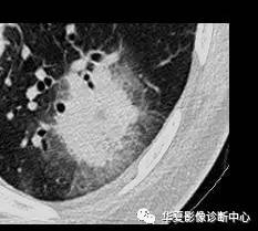 弥漫性肺泡实变影像的鉴别诊断 弥漫性肺泡实变影像的鉴别诊断