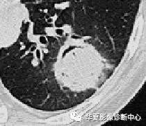弥漫性肺泡实变影像的鉴别诊断 弥漫性肺泡实变影像的鉴别诊断