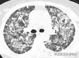 弥漫性肺泡实变影像的鉴别诊断 弥漫性肺泡实变影像的鉴别诊断