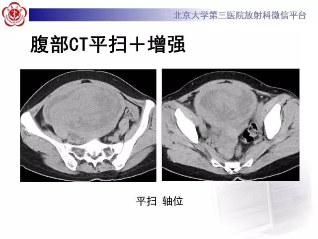 【病例】静脉内平滑肌瘤病1例CT及MR