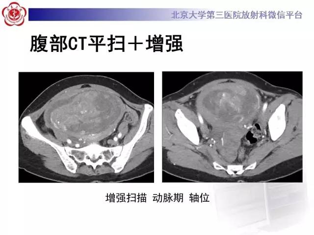 【病例】静脉内平滑肌瘤病1例CT及MR