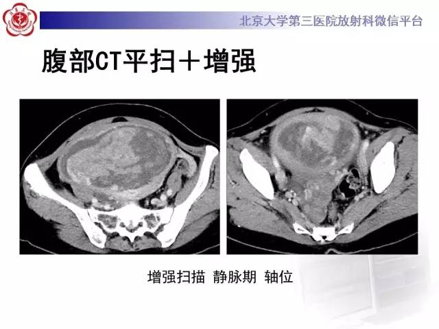 【病例】静脉内平滑肌瘤病1例CT及MR