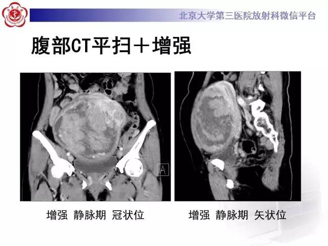 【病例】静脉内平滑肌瘤病1例CT及MR
