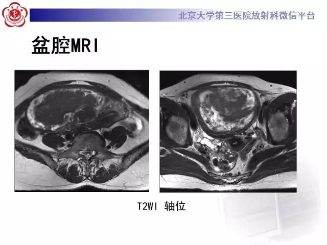 【病例】静脉内平滑肌瘤病1例CT及MR