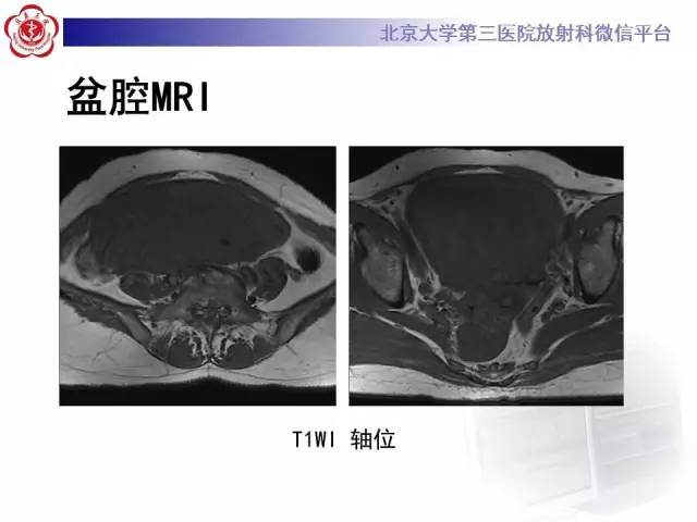 【病例】静脉内平滑肌瘤病1例CT及MR