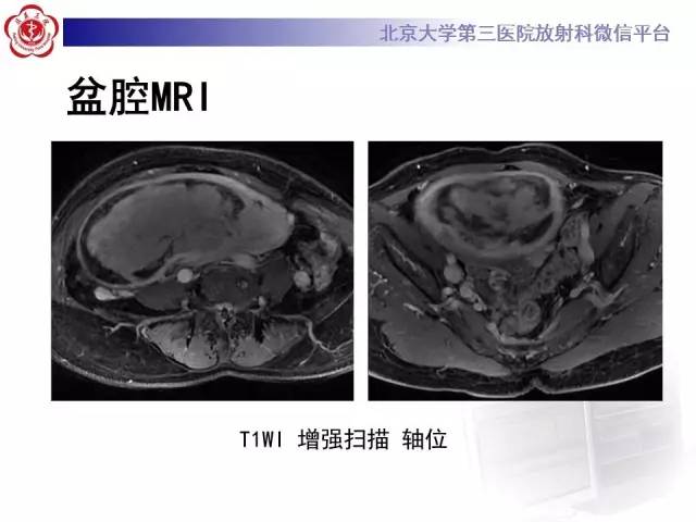 【病例】静脉内平滑肌瘤病1例CT及MR
