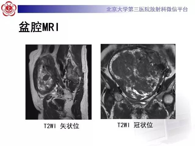 【病例】静脉内平滑肌瘤病1例CT及MR