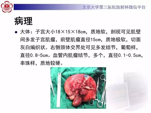 【病例】静脉内平滑肌瘤病1例CT及MR
