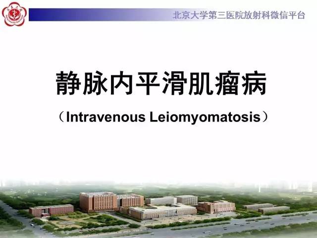 【病例】静脉内平滑肌瘤病1例CT及MR