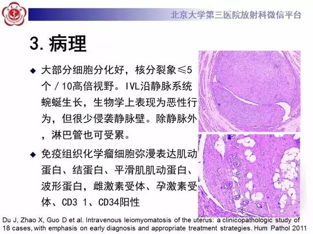 【病例】静脉内平滑肌瘤病1例CT及MR
