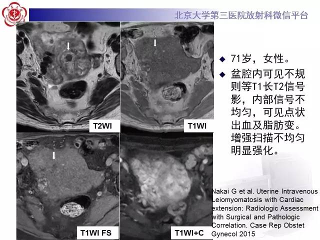 【病例】静脉内平滑肌瘤病1例CT及MR