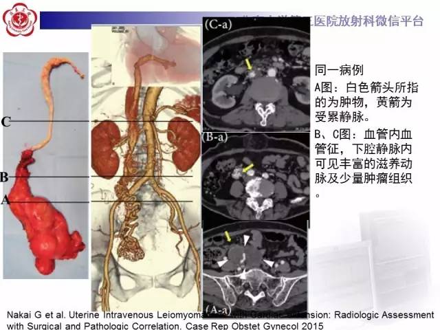 【病例】静脉内平滑肌瘤病1例CT及MR