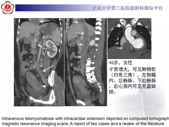 【病例】静脉内平滑肌瘤病1例CT及MR