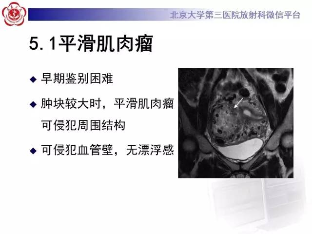 【病例】静脉内平滑肌瘤病1例CT及MR