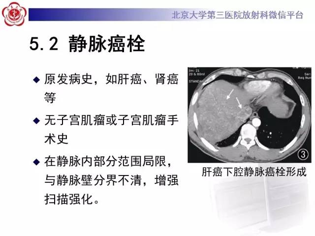 【病例】静脉内平滑肌瘤病1例CT及MR