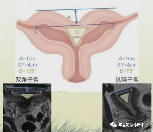双角子宫与纵隔子宫