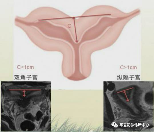 双角子宫与纵隔子宫