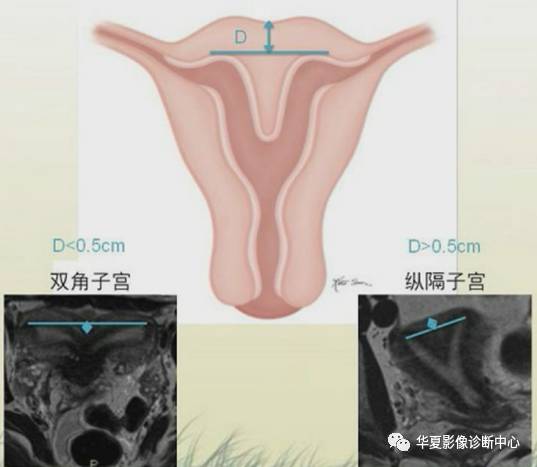 双角子宫与纵隔子宫