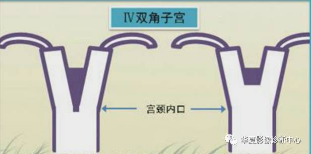 双角子宫与纵隔子宫