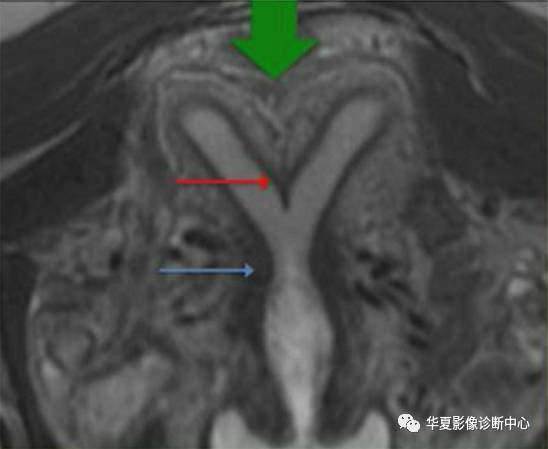 双角子宫与纵隔子宫 双角子宫与纵隔子宫