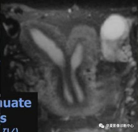 双角子宫与纵隔子宫 双角子宫与纵隔子宫