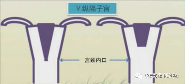 双角子宫与纵隔子宫 双角子宫与纵隔子宫