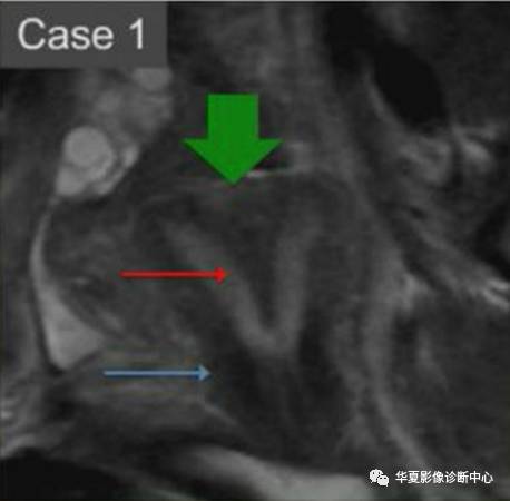 双角子宫与纵隔子宫 双角子宫与纵隔子宫