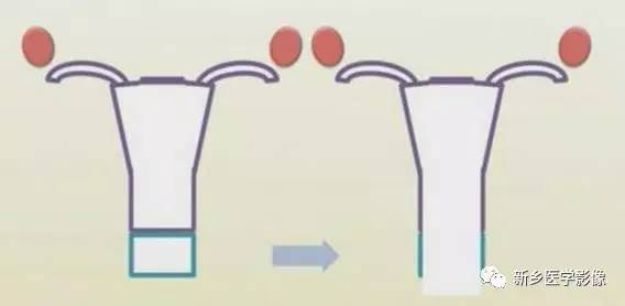 阴道发育异常，应想到的5类畸形