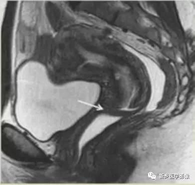 阴道发育异常，应想到的5类畸形