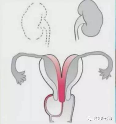 阴道发育异常,应想到的5类畸形 阴道发育异常,应想到的5类畸形
