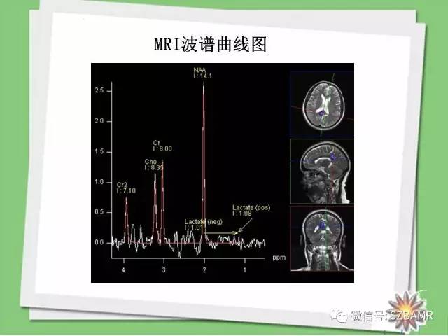 【PPT】波谱扫描技术及病例图片展示