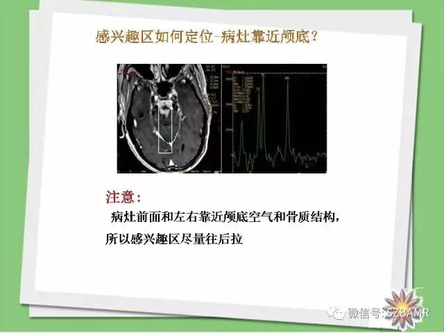 【PPT】波谱扫描技术及病例图片展示