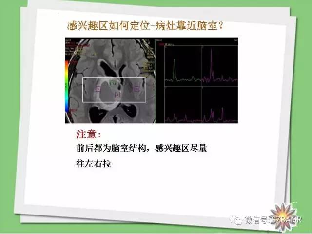 【PPT】波谱扫描技术及病例图片展示