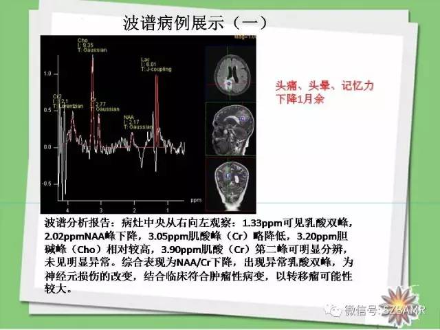 【PPT】波谱扫描技术及病例图片展示