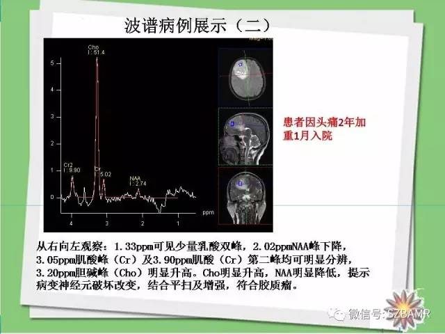 【PPT】波谱扫描技术及病例图片展示